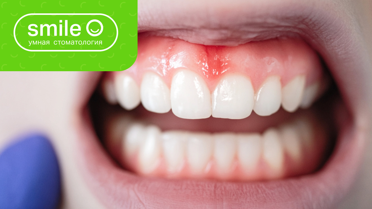 Белый налёт на деснах: нормальное явление или настораживающий сигнал?